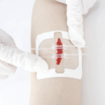 Pansements de sutures Starcare, format 7x6cm, présentés sur fond neutre. Pansements bleus, plats, avec un cœur central de gaze absorbante et un adhésif hypoallergénique. Indiqués pour une cicatrisation optimale et une protection efficace des plaies.