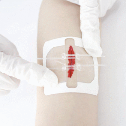 Pansements de sutures Starcare, format 7x6cm, présentés sur fond neutre. Pansements bleus, plats, avec un cœur central de gaze absorbante et un adhésif hypoallergénique. Indiqués pour une cicatrisation optimale et une protection efficace des plaies.